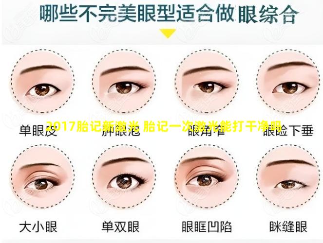 2017胎记新激光 胎记一次激光能打干净吗